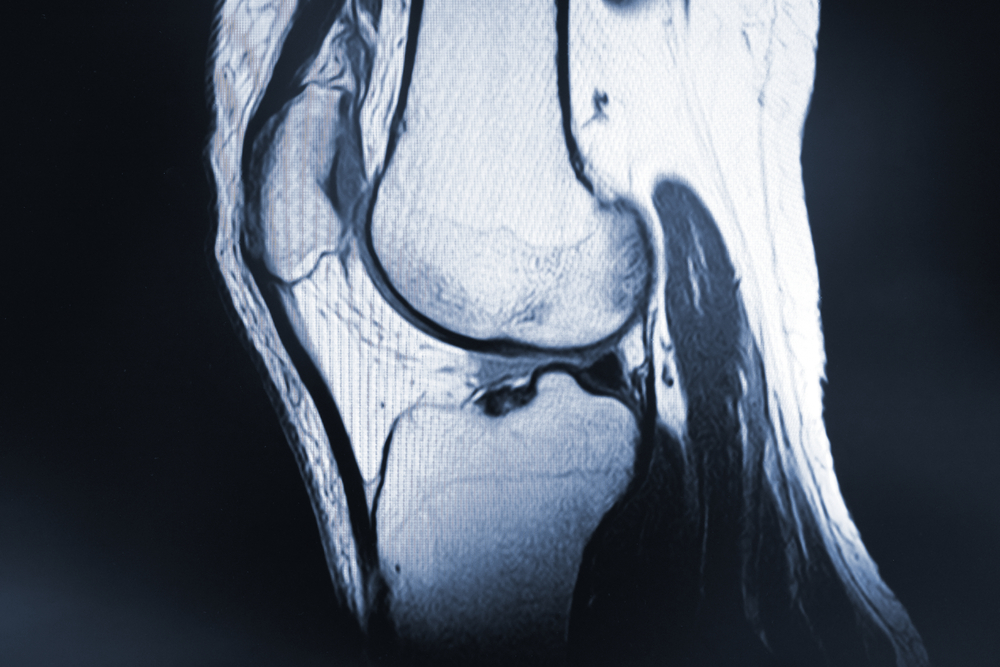 X-ray of the knee of a patient. health and medicine concept